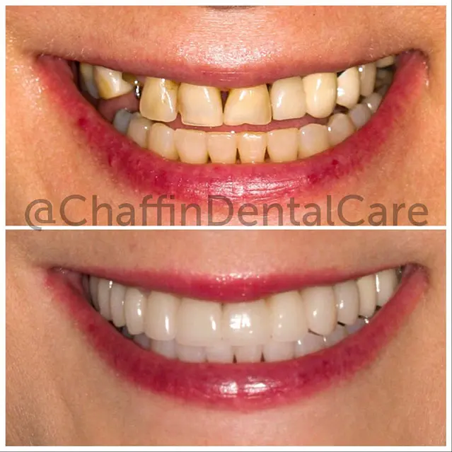 Implant Retained Bridge on 9-11 And Porcelain Crowns