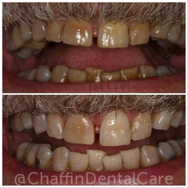 One Visit In-Office Whitening