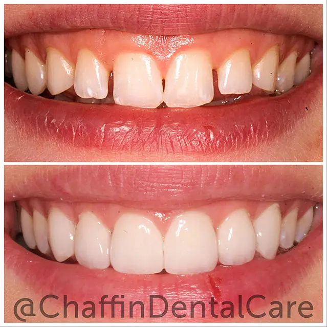 Before and after porcelain veneers smile transformation at Chaffin Dental Care