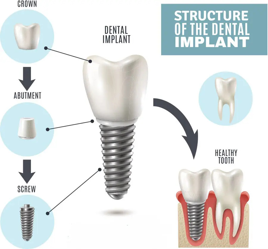 Structure of a dental implant