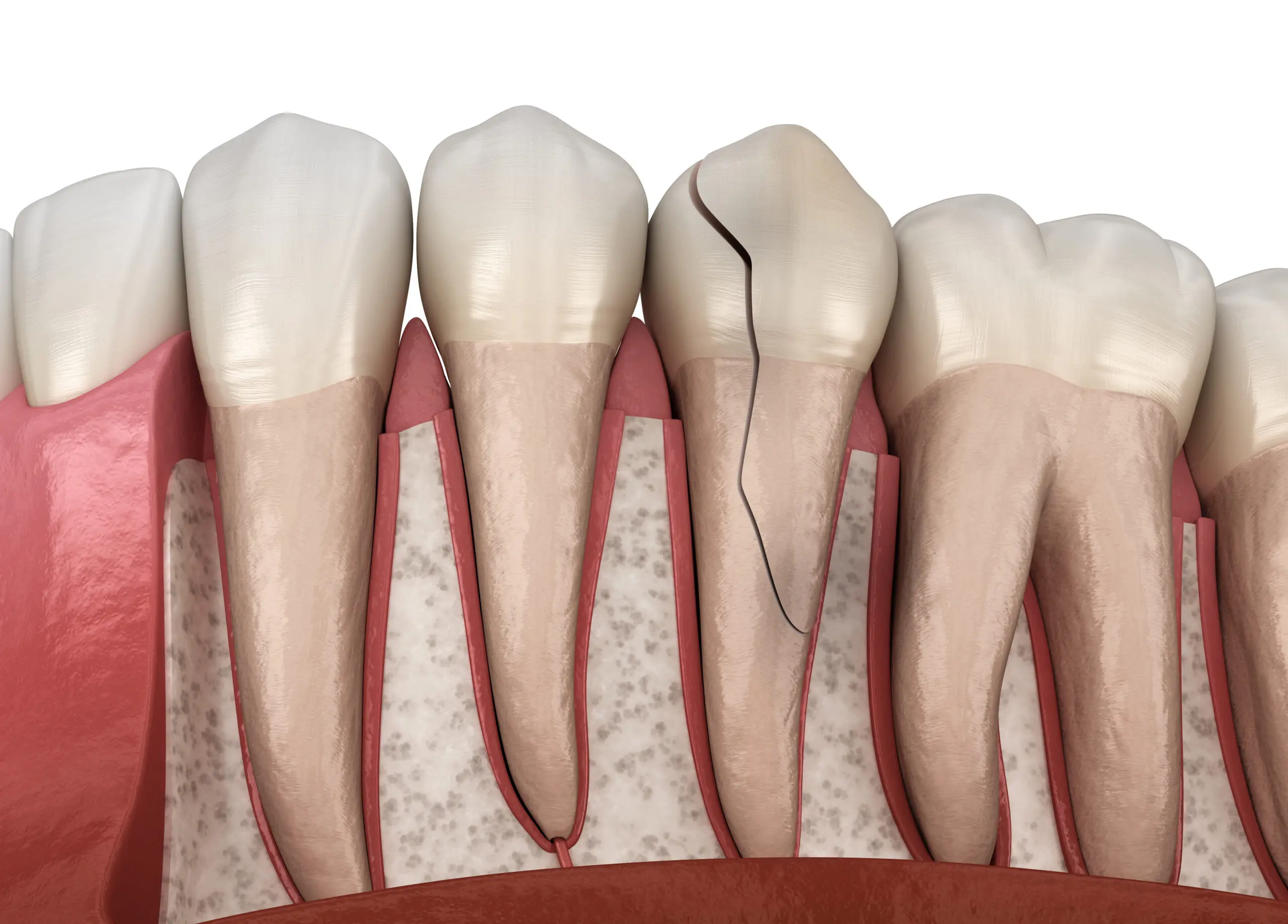 Damaged tooth that may require treatment with a dental crown
