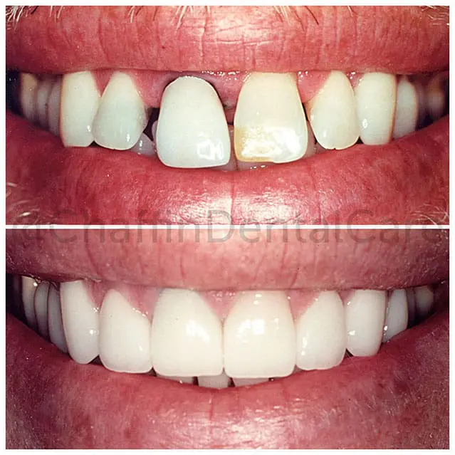 Patient smile before and after dental crown treatment