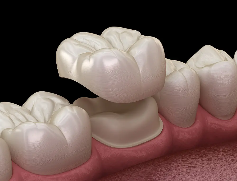 Porcelain dental crown positioned over a prepared tooth