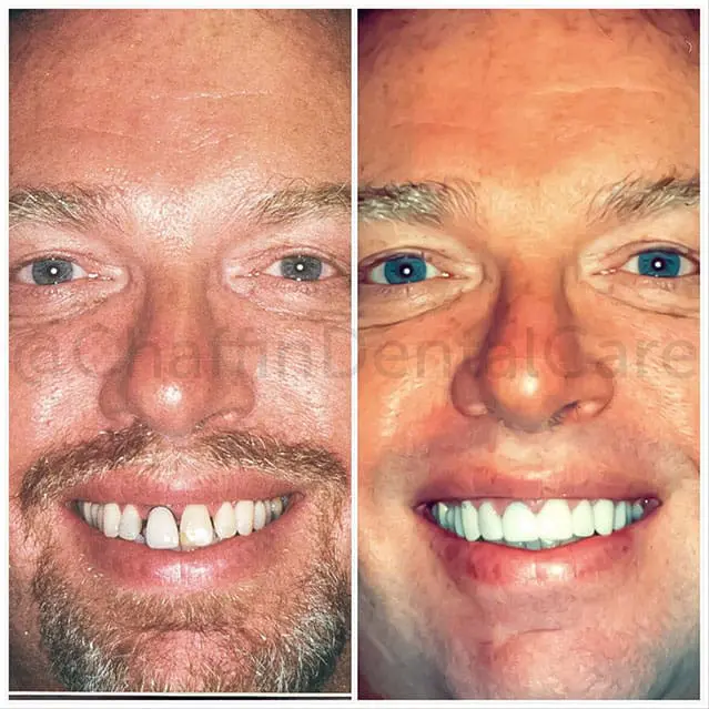 Before and after porcelain dental crown treatment at Chaffin Dental Care