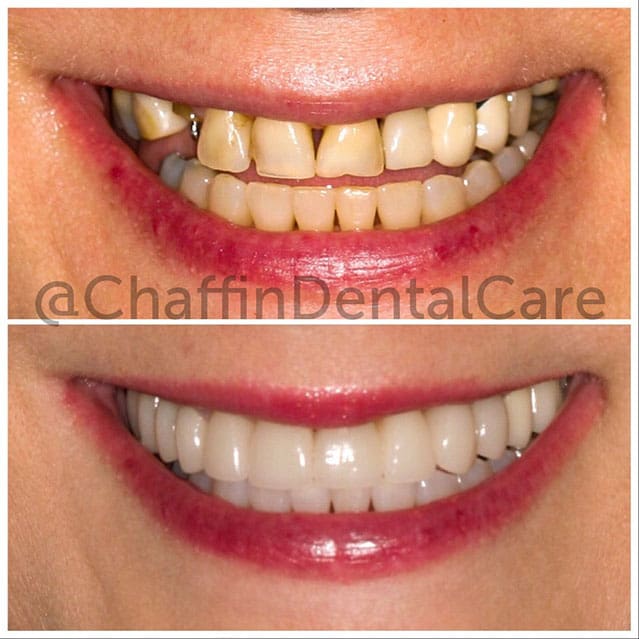 Implant Retained Bridge on 9-11 And Porcelain Crowns