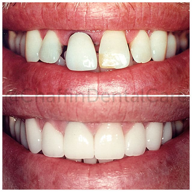 Porcelain Crowns