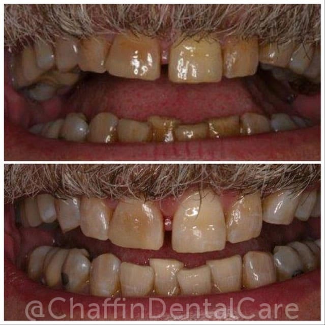 One Visit In-Office Whitening