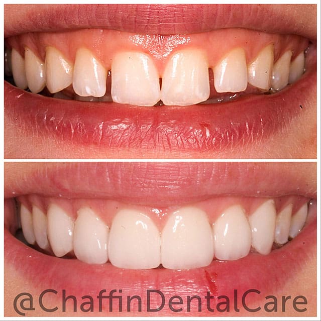 DURAthin Porcelain Veneers