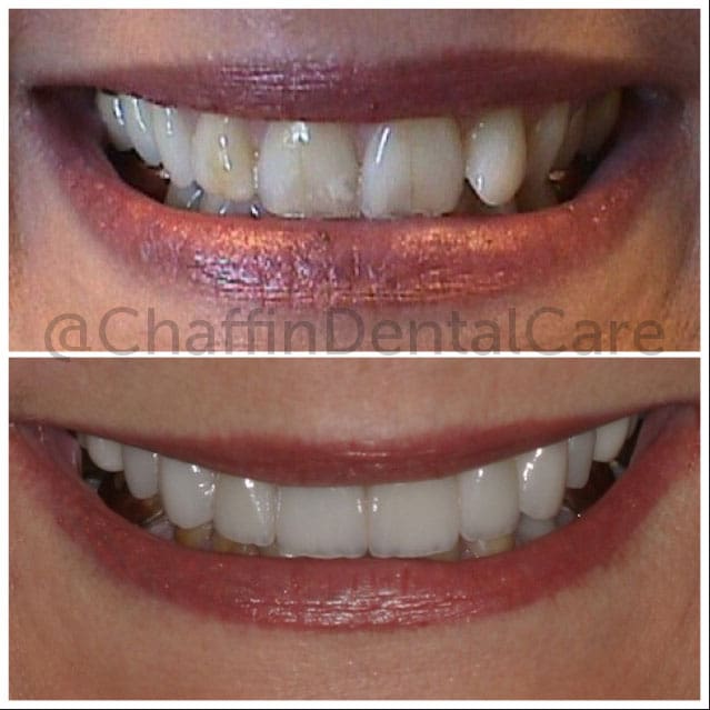 Porcelain Crowns