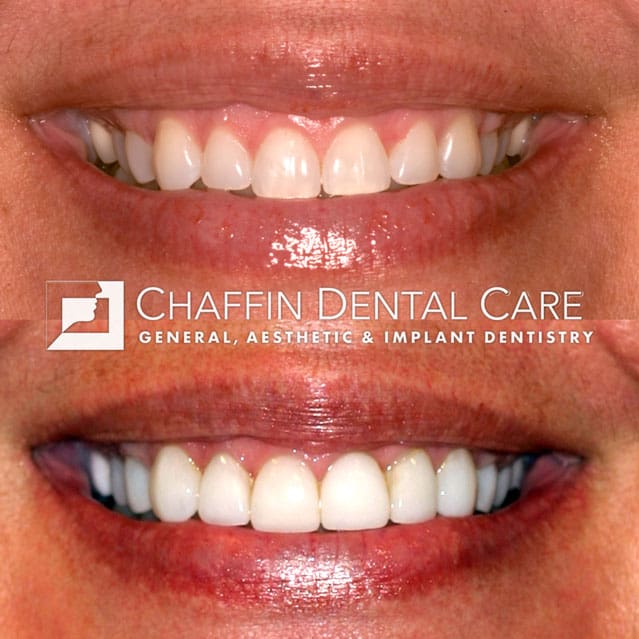 DURAthin-Porcelain-Veneers
