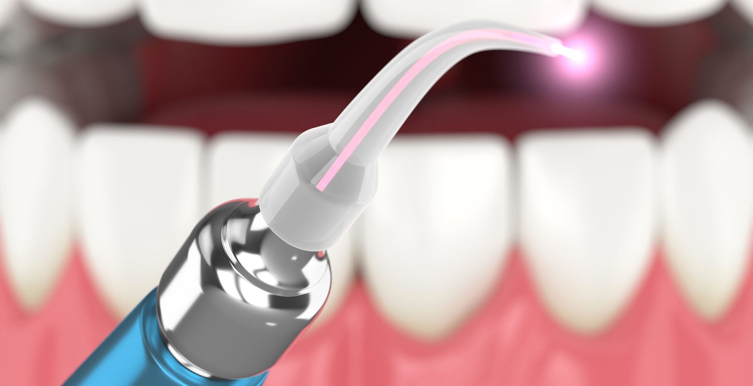 Illustration showing dental laser treatment being applied to gum tissue